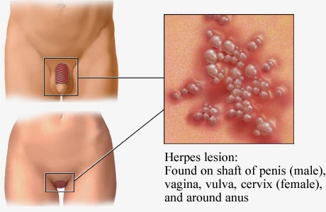 Gejala dan Penyebab Timbulnya Penyakit Herpes Berbahaya